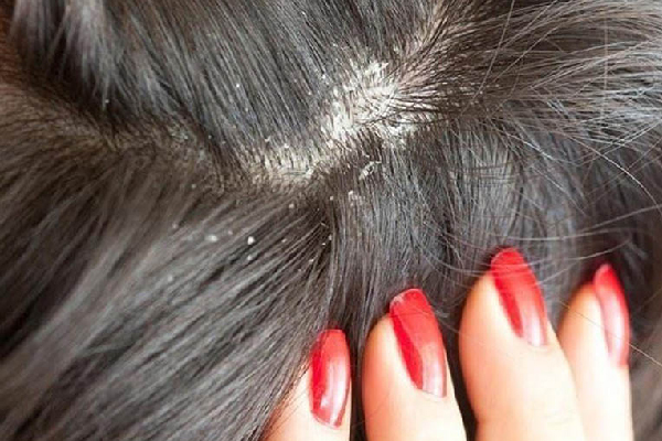 Giải quyết như thế nào khi đầu quá nhiều gàu?